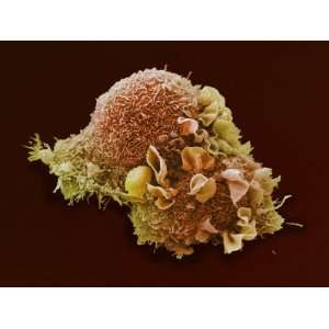  Lung Cancer, Electron Microscopy Unit, Cancer Research, UK 