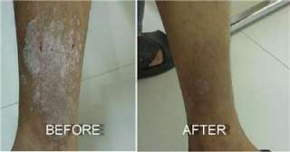 100% NATURAL HERBAL OINTMENT/CREAM FOR PSORIASIS, 2 x 10 g.  