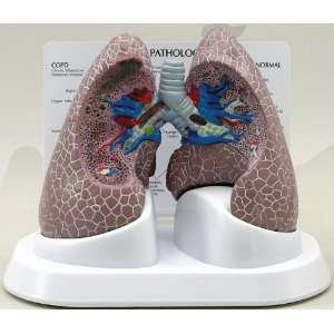 Lung Diseased COPD Anatomical Model  Industrial 